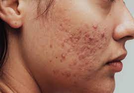 acne skin